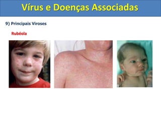 Vírus e Doenças Associadas
9) Principais Viroses
Rubéola
 