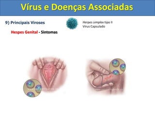 Vírus e Doenças Associadas
9) Principais Viroses
Hespes Genital - Sintomas
Herpes simplex tipo II
Vírus Capsulado
 