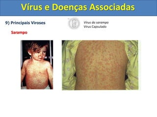 Vírus e Doenças Associadas
9) Principais Viroses
Sarampo
Vírus do sarampo
Vírus Capsulado
 