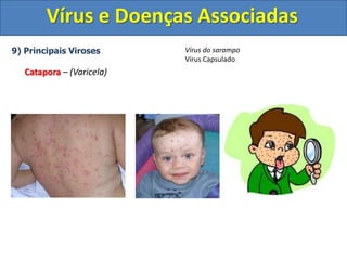 Vírus e Doenças Associadas
9) Principais Viroses
Catapora – (Varicela)
Vírus do sarampo
Vírus Capsulado
 