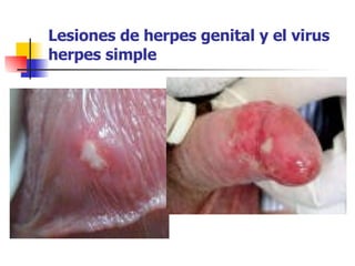 Lesiones de herpes genital y el virus herpes simple 