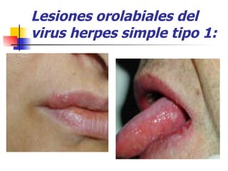Lesiones orolabiales del virus herpes simple tipo 1: 