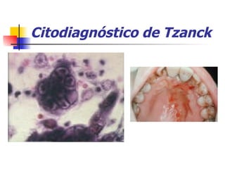 Citodiagnóstico de Tzanck 