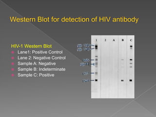 HIV-1 Western Blot






Lane1: Positive Control
Lane 2: Negative Control
Sample A: Negative
Sample B: Indeterminate
Sample C: Positive

 