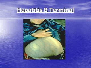 Hepatitis B Terminal
 