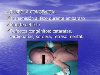 • RUBEOLA CONGÉNITA:
Transmisión al feto durante embarazo
Muerte del feto
Defectos congénitos: cataratas,
cardiopatías, sordera, retraso mental…
 