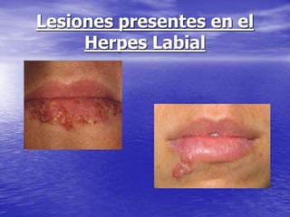 Lesiones presentes en el
Herpes Labial
 