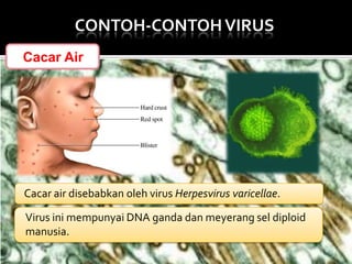 CONTOH-CONTOH VIRUS
Cacar Air

Cacar air disebabkan oleh virus Herpesvirus varicellae.
Virus ini mempunyai DNA ganda dan meyerang sel diploid
manusia.

 
