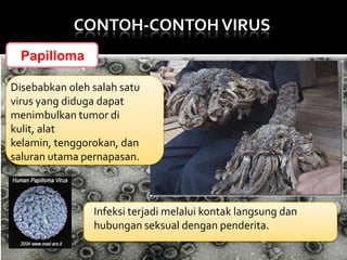 CONTOH-CONTOH VIRUS
Papilloma
Disebabkan oleh salah satu
virus yang diduga dapat
menimbulkan tumor di
kulit, alat
kelamin, tenggorokan, dan
saluran utama pernapasan.

Infeksi terjadi melalui kontak langsung dan
hubungan seksual dengan penderita.

 