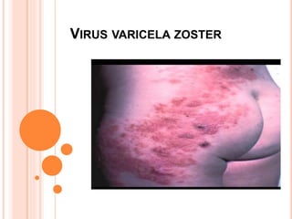 VIRUS VARICELA ZOSTER
 