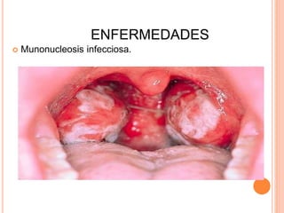 ENFERMEDADES
 Munonucleosis infecciosa.
 