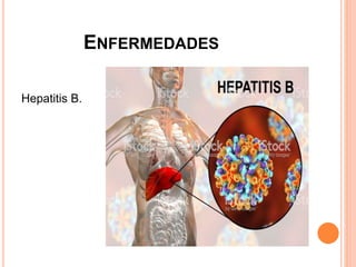 ENFERMEDADES
Hepatitis B.
 