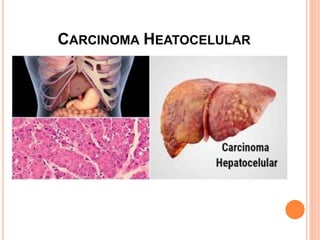 CARCINOMA HEATOCELULAR
 