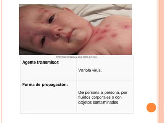 Enfermedad contagiosa y grave debido a un virus.
Agente transmisor:
Variola virus.
Forma de propagación:
De persona a persona, por
fluidos corporales o con
objetos contaminados
 