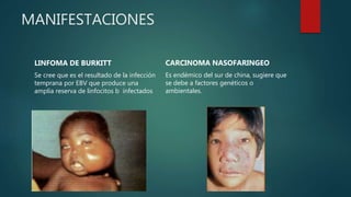 MANIFESTACIONES
LINFOMA DE BURKITT
Se cree que es el resultado de la infección
temprana por EBV que produce una
amplia reserva de linfocitos b infectados
CARCINOMA NASOFARINGEO
Es endémico del sur de china, sugiere que
se debe a factores genéticos o
ambientales.
 