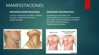 MANIFESTACIONES
MONONUCLEOSIS INFECCIOSA
La MI se caracteriza por fiebre, malestar,
faringitis, linfadenitis dolorosa y
esplenomegalia.
SINDROME PROLIFERATIVO
se presenta en pacientes con
inmunodeficiencia primaria o secundaria.
Sus rasgos mas caracteristicos sonfiebre
persitente, linfadenopatia y
hepatoesplenomegalia
 