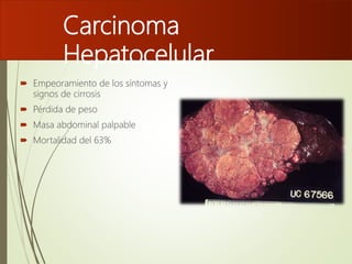 Carcinoma
Hepatocelular
 Empeoramiento de los síntomas y
signos de cirrosis
 Pérdida de peso
 Masa abdominal palpable
 Mortalidad del 63%
 