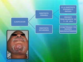 CLASIFICACION
PAROTIDITIS
PRIMARIA
ES LA PAROTIDITIS
EPIDEMICA O
PAPERAS
PRESENTE
PRINCIPALMENTE DE
5 – 16 años
PAROTIDITIS
SECUNDARIA
ES BACTERIANA Y EN
PACIENTE
INMUNOSUPRIMIDOS
 