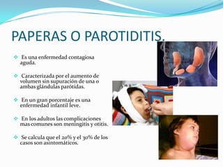 Paperas Inflamadas Virus de las paperas ó parotiditis | PPTX