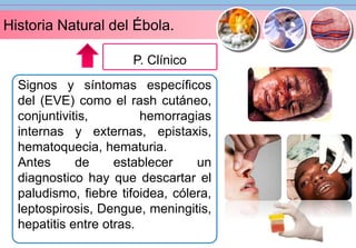 Historia Natural del Ébola. 
P. Clínico 
Signos y síntomas específicos 
del (EVE) como el rash cutáneo, 
conjuntivitis, hemorragias 
internas y externas, epistaxis, 
hematoquecia, hematuria. 
Antes de establecer un 
diagnostico hay que descartar el 
paludismo, fiebre tifoidea, cólera, 
leptospirosis, Dengue, meningitis, 
hepatitis entre otras. 
 