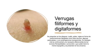 Verrugas
filiformes y
digitaformes
Se presentan en los pliegues: cuello, axilas, ingles en forma de
neoformaciones alargadas como hilos oscuros, algunas
pediculadas, o con prolongaciones transparentes. Su etiología
viral es controversial y es necesario diferenciarlas de los
tumores fibroepiteliales o acrocordon, que suelen tener la
misma topografia y se presentan en los ancianos.
 