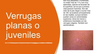 Verrugas
planas o
juveniles
Son muy pequeñas y numerosas,
no miden mas de 1 m y son muy
aplanadas, apenas se levantan de
la superficie, así es que a primera
vista parecen manchas. Son del
color de la piel, llegan a sumar mas
de 100, se localizan principalmente
en las mejillas, aunque también
pueden verse en extremidades
superiores: dorso de manos o
antebrazos mezcladas con las
verrugas vulgares. También son
asintomáticas.
 