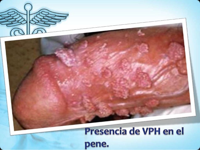 Como Curar El Papiloma Humano? Mi Historia De xito FOTOS 44 Como Curar El Papiloma Humano? Mi Historia De xito FOTOS 9