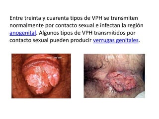 Entre treinta y cuarenta tipos de VPH se transmiten
normalmente por contacto sexual e infectan la región
anogenital. Algunos tipos de VPH transmitidos por
contacto sexual pueden producir verrugas genitales.
 