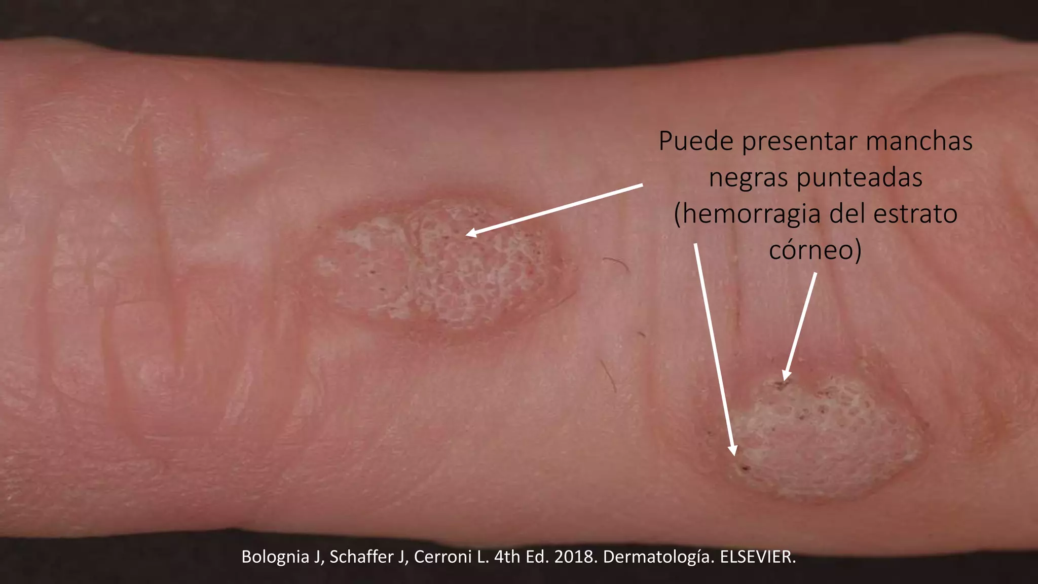 Infección por el Virus del Papiloma Humano (VPH): Verrugas Cutáneas y ...