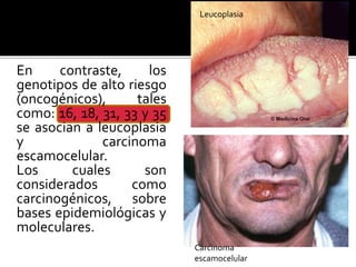 En contraste, los
genotipos de alto riesgo
(oncogénicos), tales
como: 16, 18, 31, 33 y 35
se asocian a leucoplasia
y carcinoma
escamocelular.
Los cuales son
considerados como
carcinogénicos, sobre
bases epidemiológicas y
moleculares.
Leucoplasia
Carcinoma
escamocelular
 