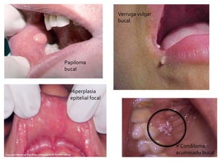 Papiloma
bucal
Verruga vulgar
bucal.
Condiloma
acuminado bucal
Hiperplasia
epitelial focal
 