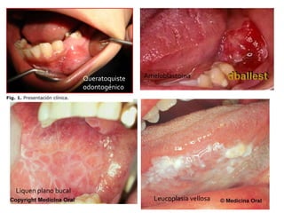 Queratoquiste
odontogénico
Ameloblastoma
Liquen plano bucal
Leucoplasia vellosa
 