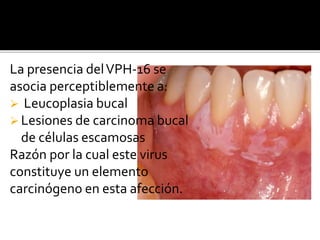 La presencia delVPH-16 se
asocia perceptiblemente a:
 Leucoplasia bucal
 Lesiones de carcinoma bucal
de células escamosas
Razón por la cual este virus
constituye un elemento
carcinógeno en esta afección.
 