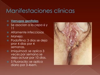    Verrugas genitales
   Se asocian a la cepa 6 y
    11
   Altamente infecciosas
   Manejo:
   Podofilina: 3 dias se deja
    pror 4 dias por 4
    semanas.
   Imiquimod: se aplica 3
    veces por semana se
    deja actuar por 10 dias.
   5 Fluoracilo: se aplica
    diario por 3-4sem.
 