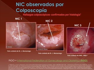 Hallazgos colposcópicos- confirmados por histología1
              NIC 1
                                                                        NIC 2
                                                                                                                               NIC 3




Foto cortesía de Dr. J. Monsonego
                                                          Foto cortesía de Dr. J. Monsonego
                                                                                                                  Foto cortesía de IARC, 2003.4


  FIGO = International Federation of Gynecology and Obstetrics (FIGO)
 1. Wright TC Jr, Cox JT, Massad LS, et al, for the ASCCP-Sponsored Consensus Congress. JAMA. 2002;287:2120–2129. 2. Bonnez W. In: Richman DD, Whitley RJ, Hayden
 FJ, eds. Washington, DC: American Society for Microbiology Press; 2002:557–596. 3. Canadian Cancer Society. Cervical Cancer: What you need to know. Available at:
 http://www.cancer.ca/vgn/images/portal/cit_86751114/63/40/151140772cw_library_wyntk_cervical_en.pdf. Accessed March 13, 2006. 4. Reprinted with permission
 from SellorsJW, Sankaranarayanan R, eds. Colposcopy and Treatment of Cervical Intraepithelial Neoplasia. A Beginner’s Manual. Lyon, France: International Agency
 