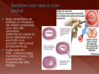    Bajo anestesia se
    extrae un muestra
    de tejido pasando
    una asa de
    alambre
    (eléctrica) sobre la
    zona displasica y
    escindir una
    porción del canal
    endocervical.
   Indicado en
    HSIL, colposcopia
    insatisfactoria, LSIL
    persistente y
    mujeres de alto
    riesgo.
 