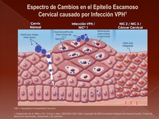 Espectro de Cambios en el Epitelio Escamoso
                Cervical causado por Infección VPH1
               Cervix                                Infección VPH /                         NIC 2 / NIC 3 /
               Normal                                     NIC* 1                            Cáncer Cervical
                                      Nuevas partículas                    Eliminación
      Partículas virales               infecciosas de                     perinuclear
        infecciosas                         virus                         (coilocitosis)
                                       Episoma
                                                                                                 ADN viral
                                                                                                integrado
                                                                                                     s




*NIC = Neoplasia Intraepitelial Cervical

1. Adaptado de A, Wilbur DC. N Engl J Med. 2003;349:1555–1564. Copyright © 2003 Sociedad Médica de Massachusetts. Todos los
derechos reservados. Adaptado con permiso.
 