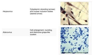 Herpesvirus
Cytoplasmic stranding (arrows)
and nuclear inclusion bodies
(dashed arrow)
Adenovirus
Cell enlargement, rounding,
and distinctive grape-like
clusters
 