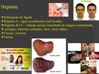 Hepatite 
Inflamação do fígado 
Hepatite A – água ou alimentos mal lavados 
Hepatite B e C – relação sexual, transfusão de sangue contaminado, 
 seringas, materiais cortantes, tatoo, fazer unhas... 
Cirrose, icterícia 
Vacina 
 