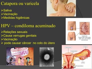 Catapora ou varicela 
Saliva 
Vacinação 
Medidas higiênicas 
HPV – condiloma acuminado 
Relações sexuais 
Causa verrugas genitais 
Vacinação 
 pode causar câncer no colo do útero 
 