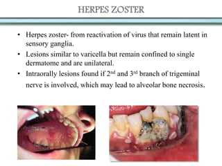 HERPES ZOSTER
• Herpes zoster- from reactivation of virus that remain latent in
sensory ganglia.
• Lesions similar to varicella but remain confined to single
dermatome and are unilateral.
• Intraorally lesions found if 2nd and 3rd branch of trigeminal
nerve is involved, which may lead to alveolar bone necrosis.
 