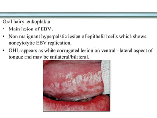 Oral hairy leukoplakia
• Main lesion of EBV .
• Non malignant hyperpalstic lesion of epithelial cells which shows
noncytolytic EBV replication.
• OHL-appears as white corrugated lesion on ventral –lateral aspect of
tongue and may be unilateral/bilateral.
 