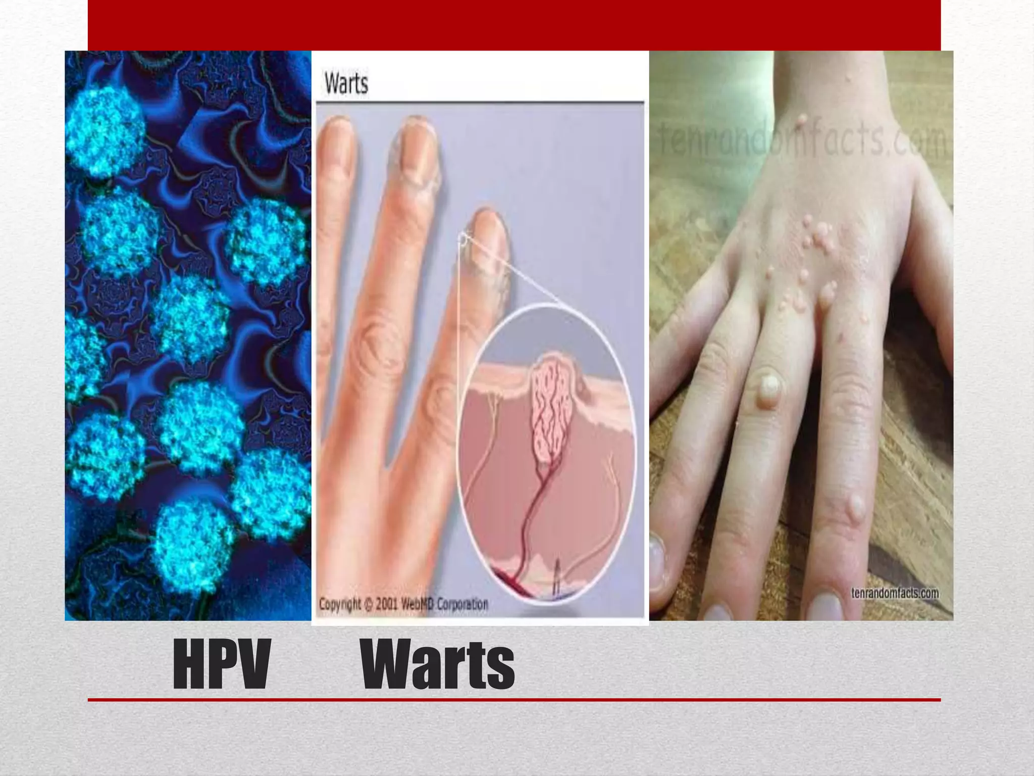WartsHPV
 