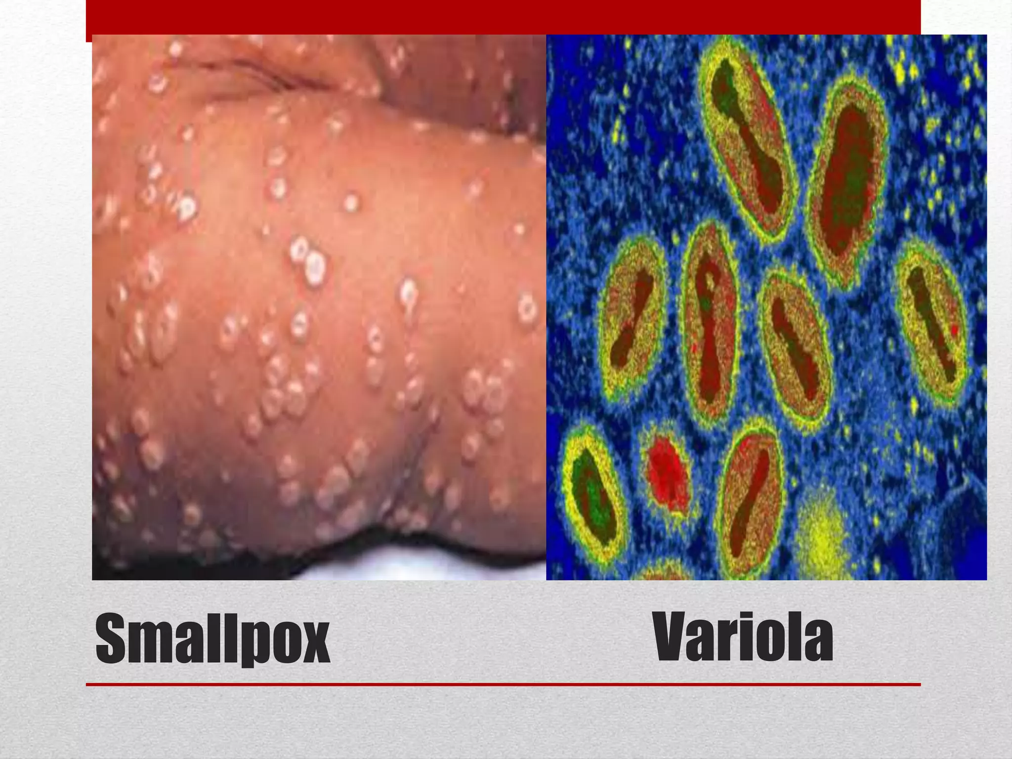 Smallpox Variola
 