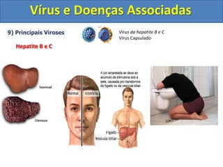 Vírus e Doenças Associadas9) Principais VirosesHespes Bucal - Sintomas Herpes simplex tipo IVírus Capsulado