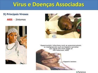 Vírus e Doenças Associadas9) Principais VirosesHepatite B e C	Agente Etiológico: Vírus da Hepatite B e C	Forma de transmissão: Contato com o sangue de pessoas contaminadas. Geralmente o contágio se dá por contato sexual, compartilhamento de seringas e transfusão de sangue.	Sintomas: Inflamação do fígadoDores de cabeça e do corpo		        Pele e olhos amarelados		        Náuseas		        Vômitos	Tratamento: Utilização de medicamentos que inibem a ação viral.	Profilaxia: Vacina – Hepatite B. Medicamentos antiviruais Hepatite C - Uso de preservativos nas relações sexuais, controle dos bancos de sangue, utilizar somente seringas descartáveis e não as compartilhar.A hepatite C se não tratada rapidamente pode evoluir para o quadro de cirrose.