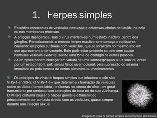 Herpes simples Episódios recorrentes de vesículas pequenas e dolorosas, cheias de líquido, na pele ou nas membranas mucosas. A erupção desaparece, mas o vírus mantém-se num estado inactivo  dentro dos gânglios. Periodicamente, o mesmo herpes reactiva-se e começa a replicar-se, causando erupções cutâneas com vesículas, que se localizam no mesmo sítio em que apareceram anteriormente. Este pode estar presente na pele sem causar nenhuma vesícula evidente, sendo uma fonte de contágio de outras pessoas.  As erupções podem começar em virtude de uma sobreexposição à luz solar ou então por um estado febril, pelo  stress  físico ou emocional, pela supressão do sistema imunitário ou pela tomada de certos alimentos ou medicamentos Os dois tipos de vírus do herpes simples que infectam a pele são VHS-1 e VHS-2. O VHS-1 é o que determina a formação de vesículas sobre os lábios (herpes labial)    e úlceras na córnea do olho , em geral transmite-se por contacto com secreções da boca ou da sua vizinhança. O VHS-2 costuma causar o herpes genital e é transmitido principalmente por contacto directo com as vesículas, quase sempre durante uma relação sexual.  Imagem do vírus do herpes simples ao microscópio electrónico 