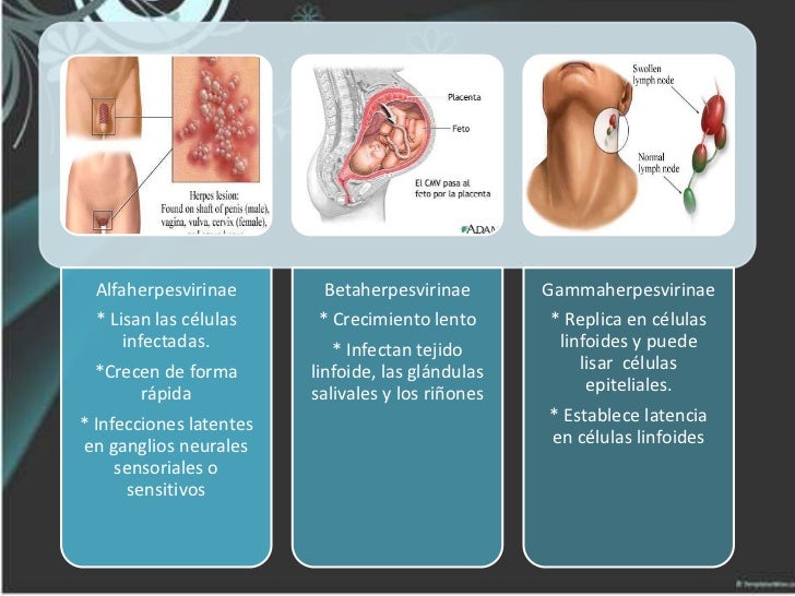 an overview of the simple virus 1 hsv 1 and simplex virus type hsv 2 Herpes simplex: overview most cold sores are caused by herpes simplex virus type 1 (hsv-1) genital herpes (herpes simplex type 2. an overview of the simple virus 1 hsv 1 and simplex virus type hsv 2 Herpes simplex: overview most cold sores are caused by herpes simplex virus type 1 (hsv-1) genital herpes (herpes simplex type 2.