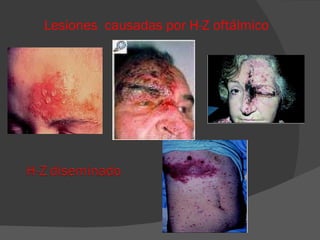 Lesiones  causadas por H-Z oftálmico  