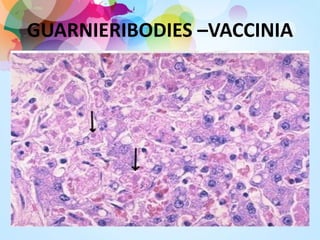 GUARNIERIBODIES –VACCINIA
 